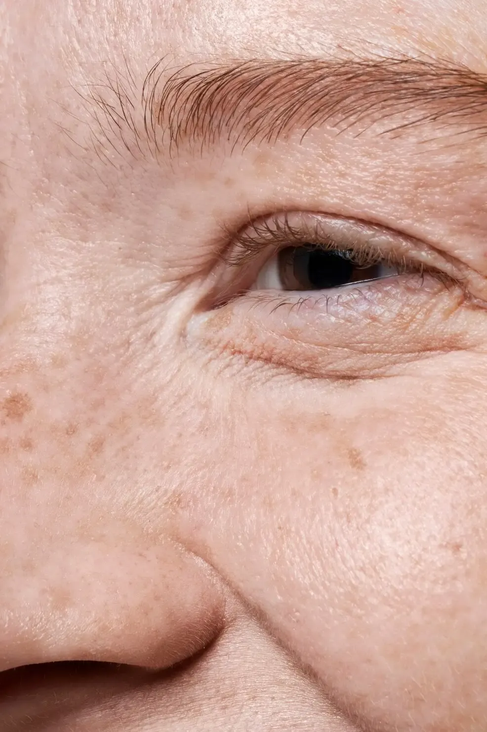 Pele com manchas de melasma próximas à região dos olhos