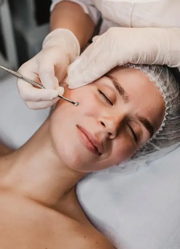 Procedimento dermatológico para tratamento de acne em consultório