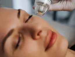 Radiofrequência Microagulhada