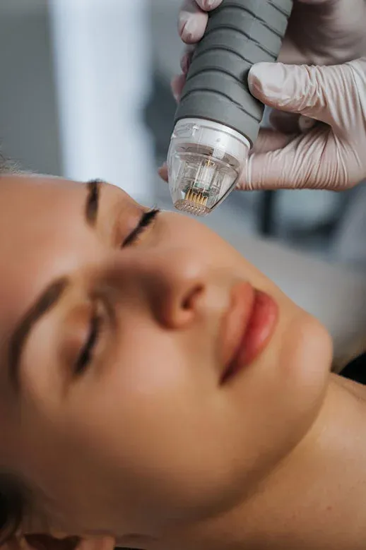 Radiofrequência microagulhada em consultório dermatológico em Ribeirão Preto
