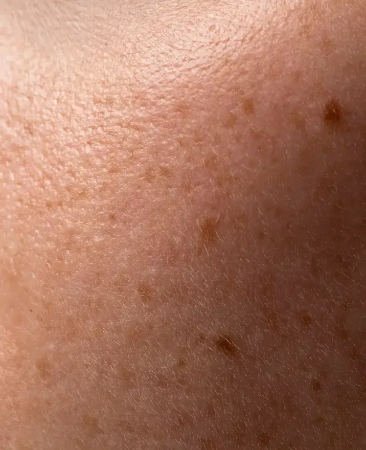Exame da pele para avaliação dos sinais de melasma