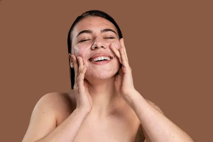 Mulher sorridente lavando o rosto com pele com acne