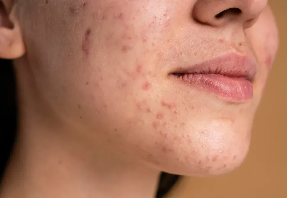 Tratamento de acne em consultório dermatológico em Ribeirão Preto
